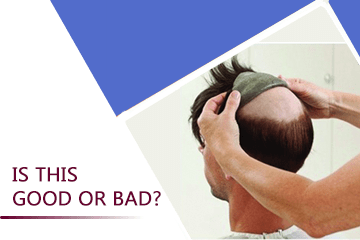 What is a non-surgical hair replacement? Is this Good or Bad