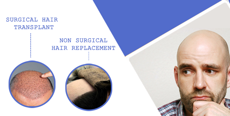 Which is better Non-Surgical Hair Replacement or Hair Transplant